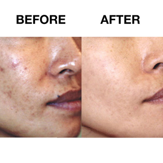 30 Day Sensitive Skin Acne Lotion + Clarifying Toner