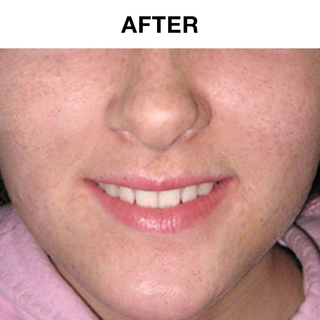 30 Day Acne Treatment Kit- Benzoyl Peroxide