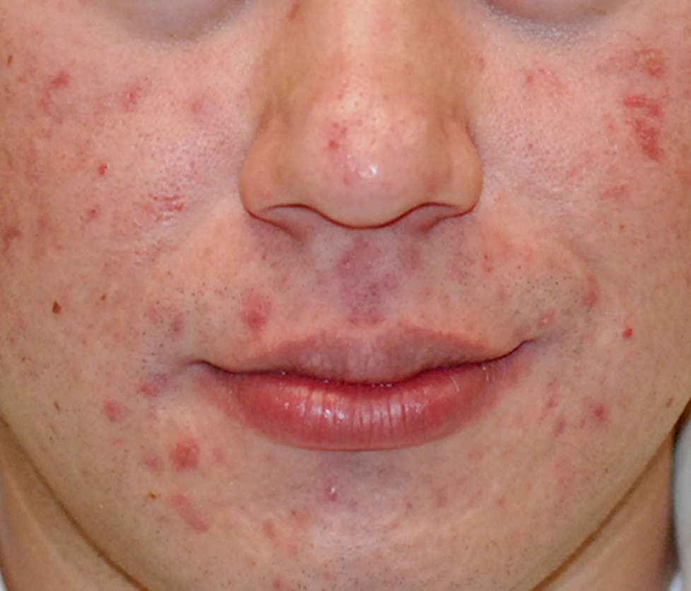 30-Day Sensitive Skin Acne Clearing 3 Step Treatment with Salicylic Acid - Clearogen