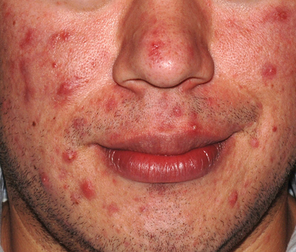 30-Day  Ultimate Acne Clearing 3-Step Treatment with 2.5% Benzoyl Peroxide - Clearogen