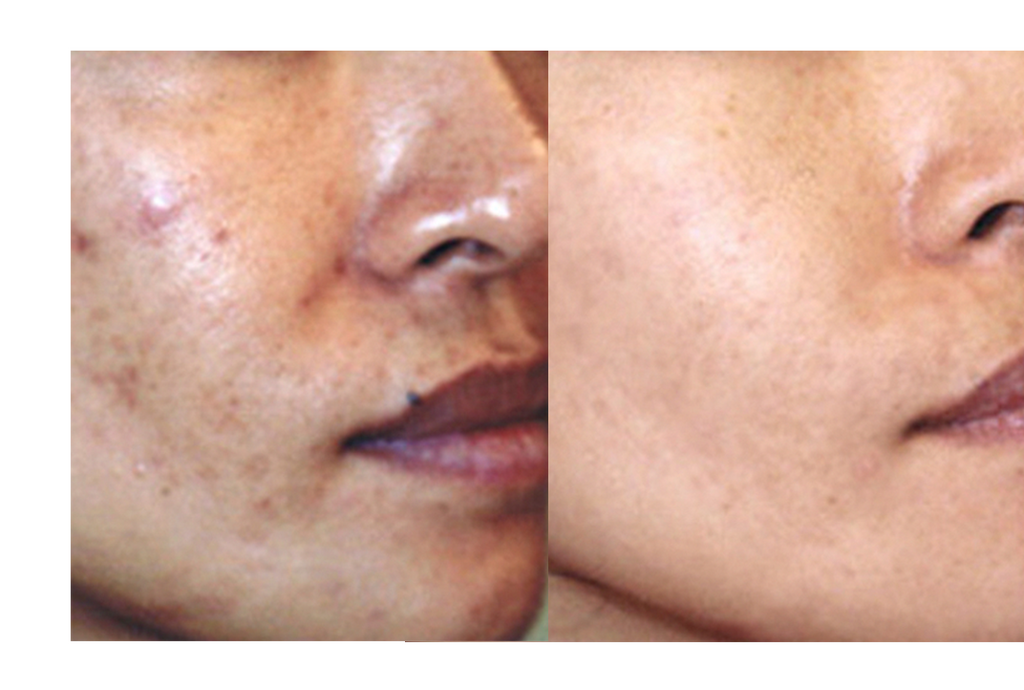 30-Day Sensitive Skin Acne Clearing 3 Step Treatment with Salicylic Acid - Clearogen