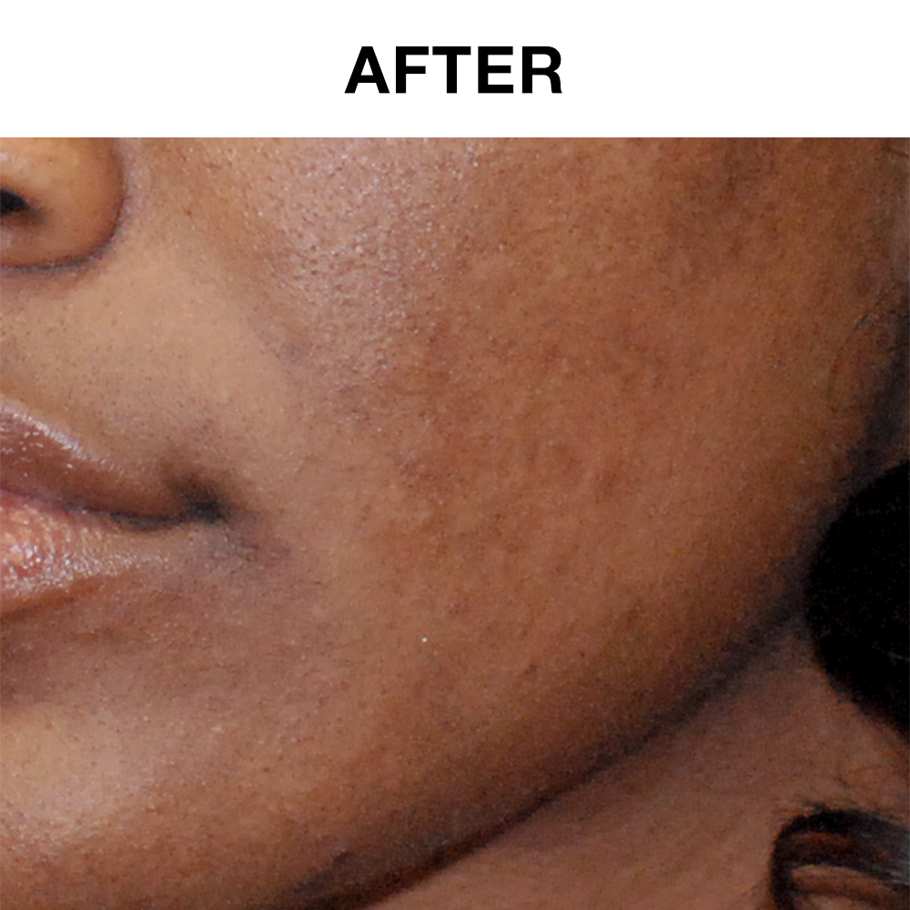 60-Day Ultra-Foaming Facial Cleanser with Salicylic Acid - Clearogen