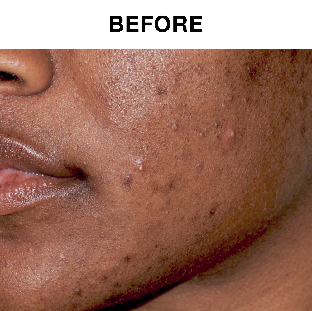 60-Day Ultra-Foaming Facial Cleanser with Salicylic Acid - Clearogen