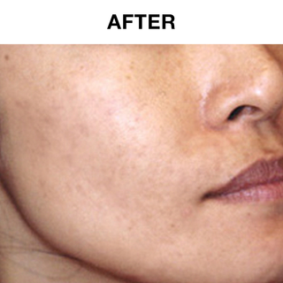 30 Day Acne Treatment Kit for Sensitive Skin