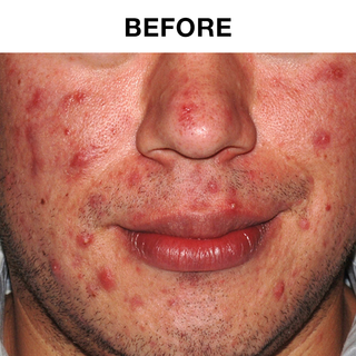 30 Day Sensitive Skin Acne Lotion