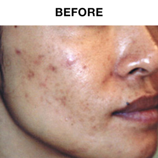 60 Day Sensitive Skin Acne Lotion