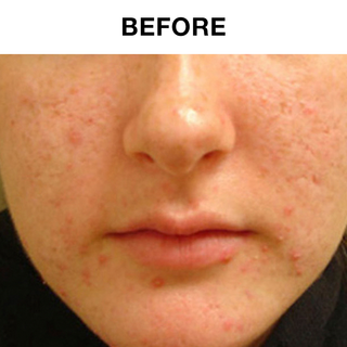 120 Day Acne Lotion  Sensitive Skin Bulk 4 Pack